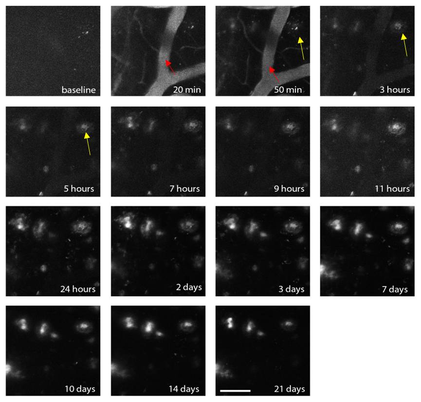 Follow-up brain MRI