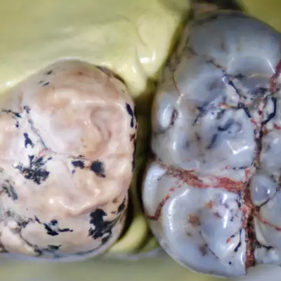 Dents appartenants à un Homo ancien (à gauche) et à un « Paranthropus robustus » (à droite). 