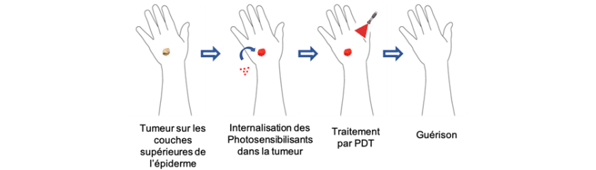 Principe de la Thérapie photodynamique (PDT)