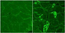 Biopsies de muscles : à gauche, muscle sain / à droite, muscle atteint de myosite à corps d'inclusion et marquage fluorescent des agrégats protéiques